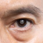 cataracts